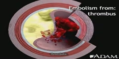 Introduction With Embolism and Strokes