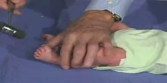 Deep Tendon Reflexes- Clinical Examination Of New Born Child