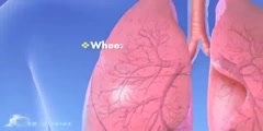 What is Asthma?