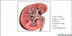 Kidney Stones- Reason Behind It
