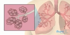 Effect of Pneumonia On Lungs