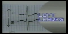 ECG Reading With Axis Deviation