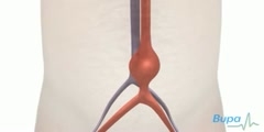 Abdominal hysterectomy procedure  - Scientific Video and  Animation Site