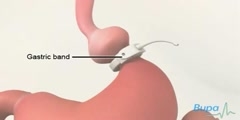 Gastric Banding Surgery- How It Is Carried Out
