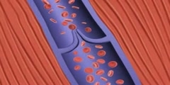 Formation of Deep Vein Thrombosis