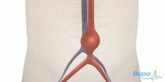 Keyhole Abdominal Aortic Aneurysm Surgery- How A Surgeon do it