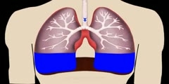 Pleural Fluid in Lungs
