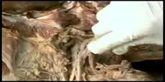 Anatomy of Brachial Plexus From Upper Limb
