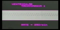 ECG Reading For Ventricular Rhythms