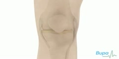 Knee Arthroscopy