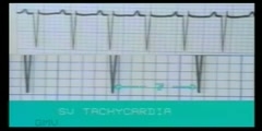 Types Of Atrial Rhythms