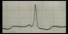 ECG Reading for WPW Syndrome