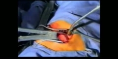 Intercostal Drain Surgery Video