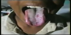Tongue Clinical Signs- Identification