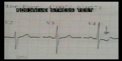 ECG reading for myocardial ischemia - Dr. Vaidya