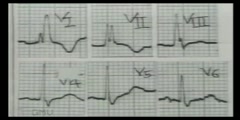 How To Read An ECG?