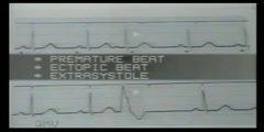 What is Arrhythmia?