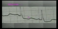 26. How To Read ECG Reading- T Wave Inversions