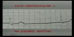 ECG Reading