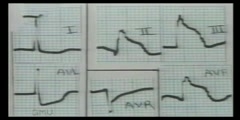 ECG Reading of a Myocardial Infarction