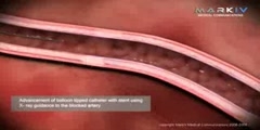 Treatment of Atherosclerosis