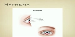 Introduction With Hyphema