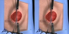 Open Hernia Surgery Video