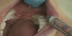 Introduction With Long Buccal Injection