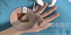 Wrist Arthroscopy Animation