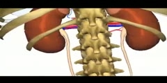 All About Kidney Stones