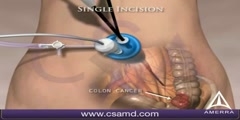 Single Incision Laparoscopic Colectomy Technique utilizing SILS port