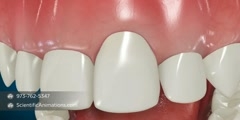 crown lengthening procedure