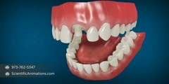 Dental Restoration - Crowns on Teeth