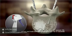 Bone Cement Procedure - Spine Animation