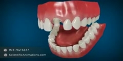 Dental Cap Procedure