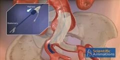 AAA Stent Training - 3d Medical Animation