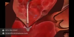 Mitral Valve Repair