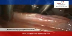 Minimally Invasive Cardiac Surgery