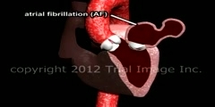 Atrial fibrilation