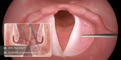 Vocal Cord Reconstruction