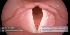 Reconstruct Vocal Cord