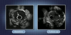 Stent Implant Procedure