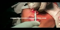 Nose Reshaping  In India