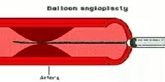 Balloon angioplasty animation video