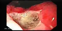 Giant gastric ulcers endoscopy