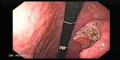 Endoscopy of Small Gastric Cancer taken by Dr. Julio Murra S
