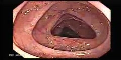 Video clip of a Colonoscopy Taken by Dr. Julio Murra-Saca