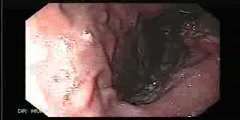 Stomach cancer: as seen by endoscopy