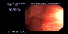 Lateral internal sphincterotomy treatment  - Scientific Video  and Animation Site