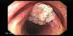 Cancer of the larynx as seen through endoscopy.